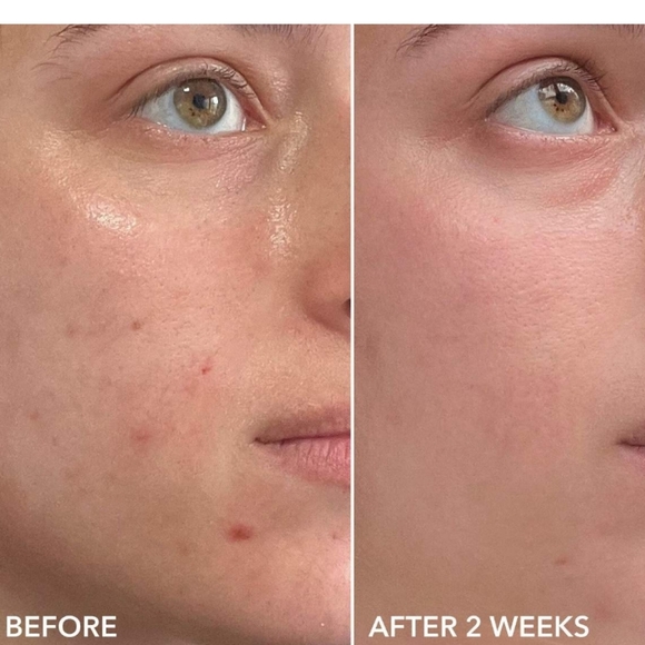 NIB DR.DENNIS GROSS ALPHA BETA 2% BREAKOUT SOLUTION - Picture 9 of 16